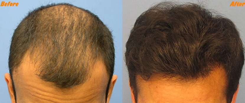 Address Your Hairlessness with the Best Hair Fixing Services in Delhi
