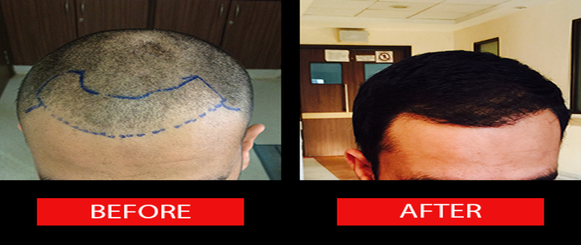 Hair Transplantation: Important Facts To Know
