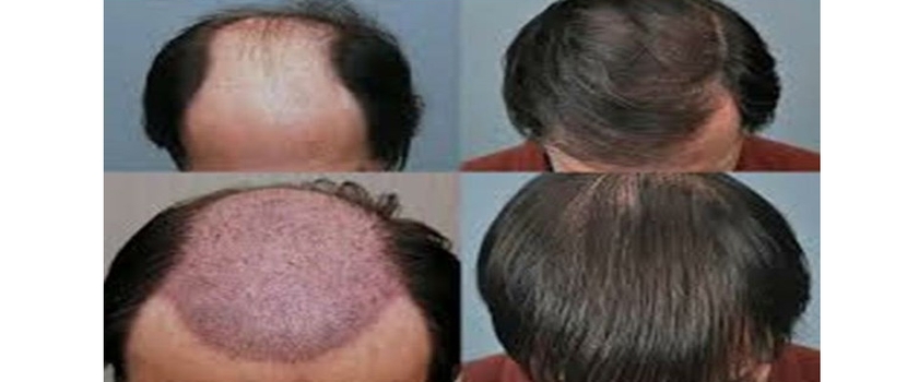 Say Goodbye to Baldness with Hair Weaving