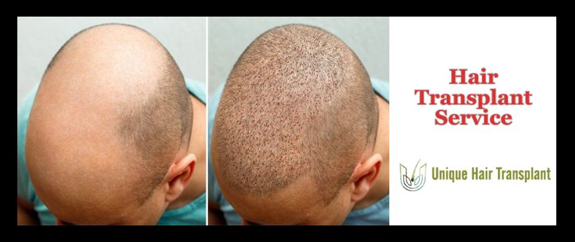 The Perks of Hair Transplantation - Restoring Confidence and Natural Beauty