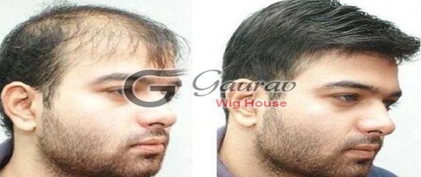 The Reason Why Everyone Love Hair Fixing Services Delhi