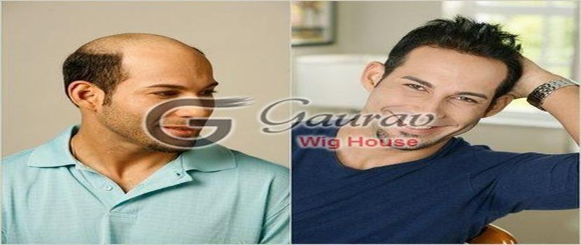 Female Hair Transplant in Delhi  Women Hair Transplant cost in India  DermaClinix